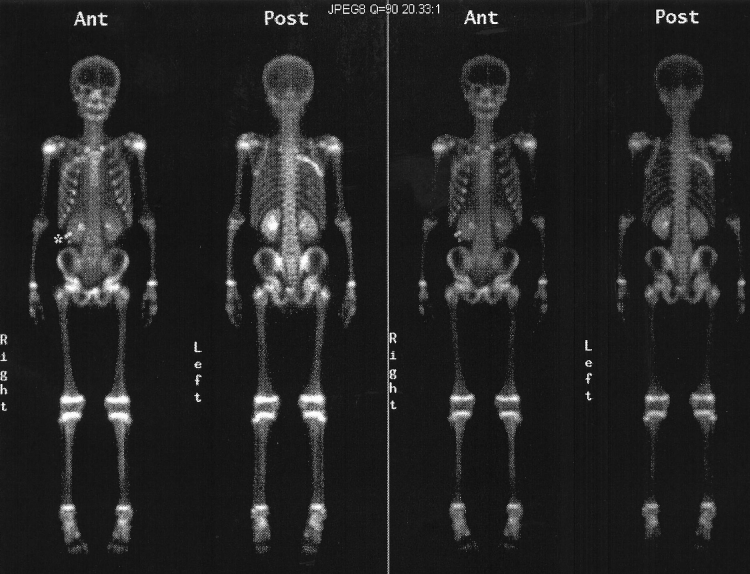 DeadSarcoma.png